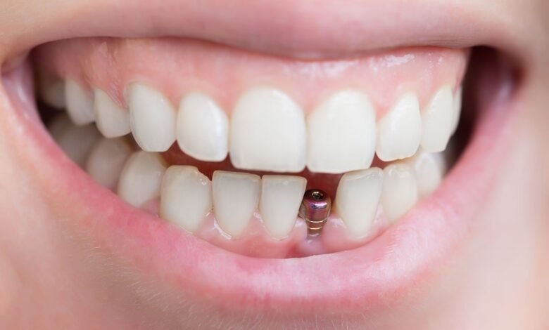 dental implants hungary helvetic clinics